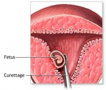 Gentle Vacuum Aspiration Abortion